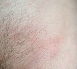 psoriasis photo in groin, after
