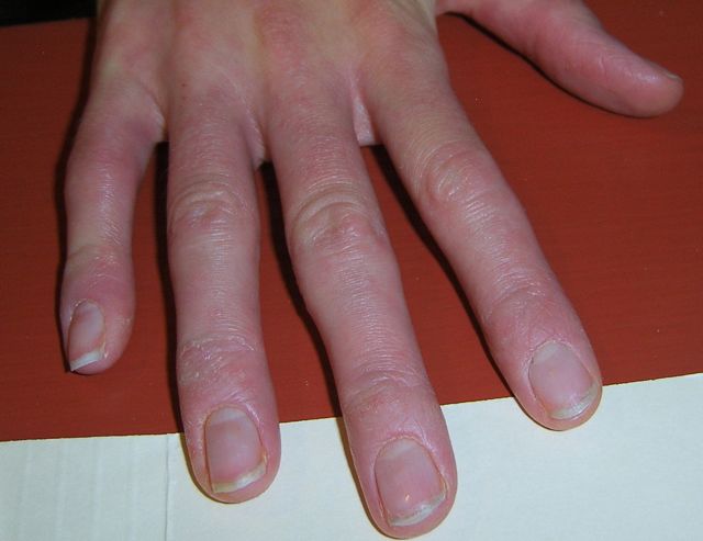 hand eczema cure