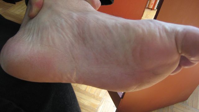 Itchy Blisters On Bottom Of Feet - Doctor answers on HealthTap
