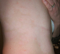 PLAQUE PSORIASIS PICTURE AFTER TREATMENT