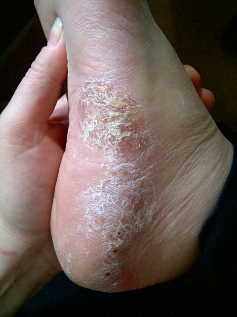 images of eczema and psoriasis on feet