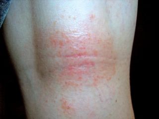 rash behind knee