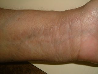 eczema wrist cure