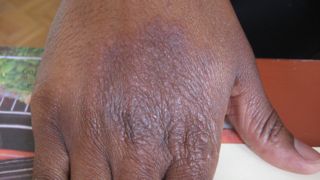 black skin rash