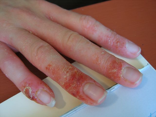 blisters on hands eczema pompholyx picture