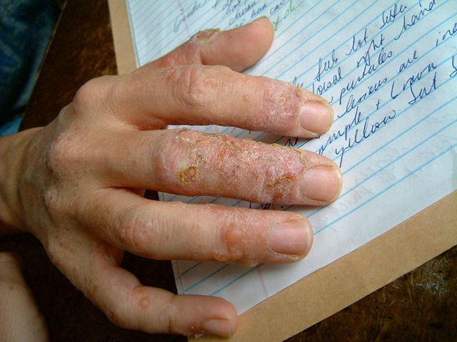 severe eczema pictures