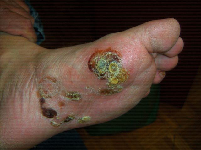 infected eczema on feet before