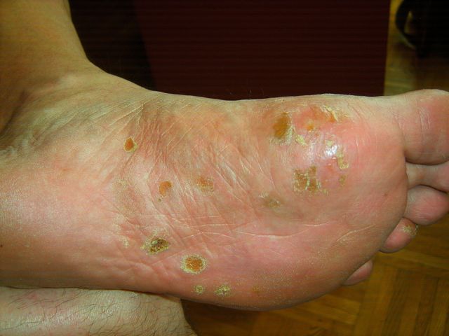 picture of blisters on feet