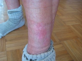 skin treatment psoriasis photo