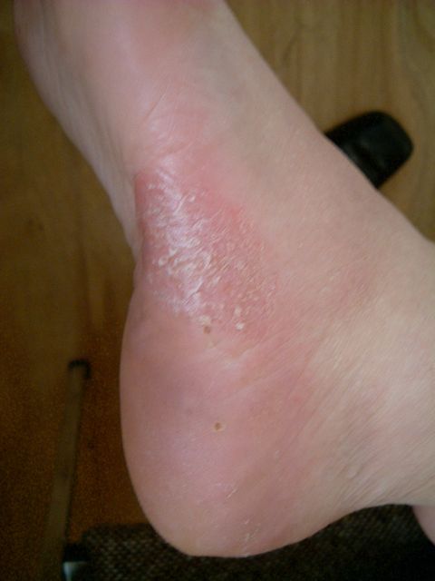 picture of pustular psoriasis on feet after