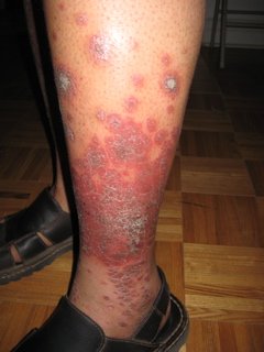 psoriasis leg picture